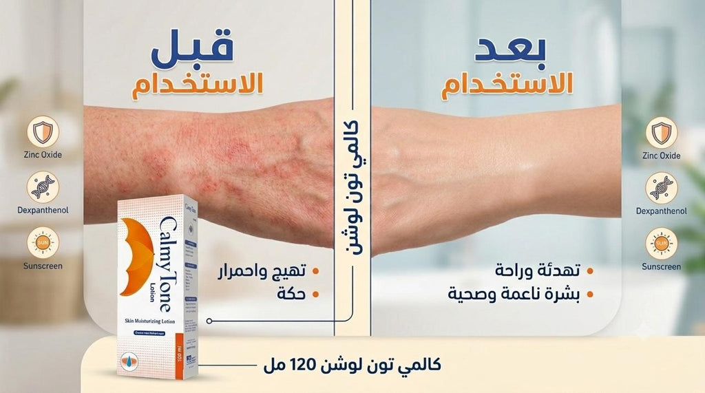 Before and after comparison of skin with a Calmylone product, showing irritation on the left and smooth skin on the right.
